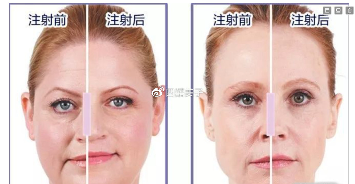 最新脸部填充技术，引领时代美容革命的新潮流